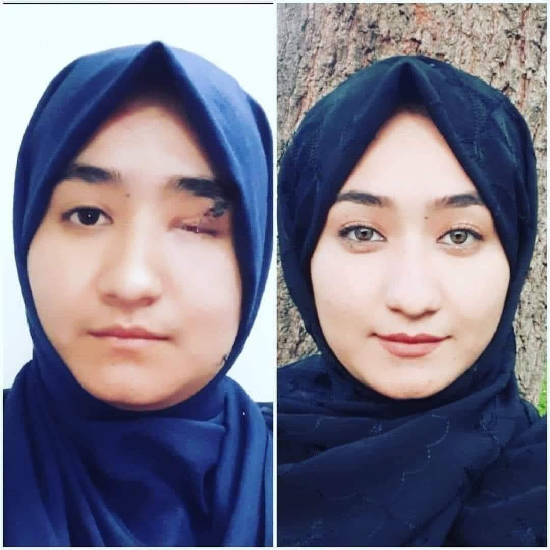 فاطمه امیری، دانش‌آموزشی که یک چشم و شنوایی گوش را در انفجار آموزشگاه از دست داد، در دانشگاه کابل قبول شد. عکس: شبکه‌های اجتماعی